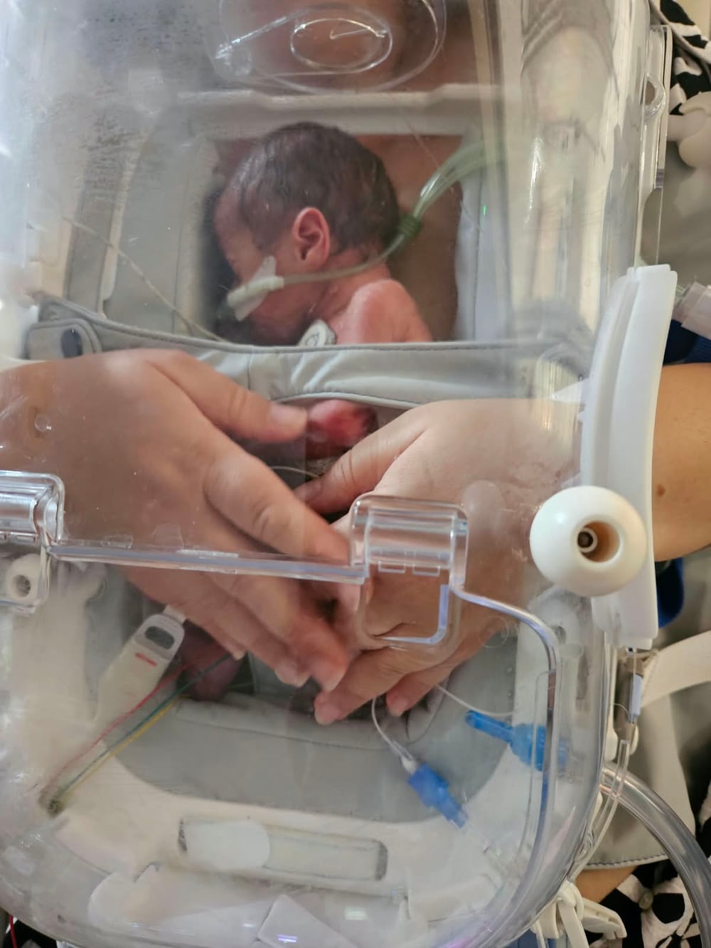 Two hands resting on a preterm baby through the clear cover of the Skincubator