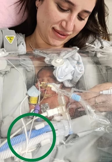 A mother holding her ventilated baby in the Skincubator, the breathing circuit and lines anchored to the device
