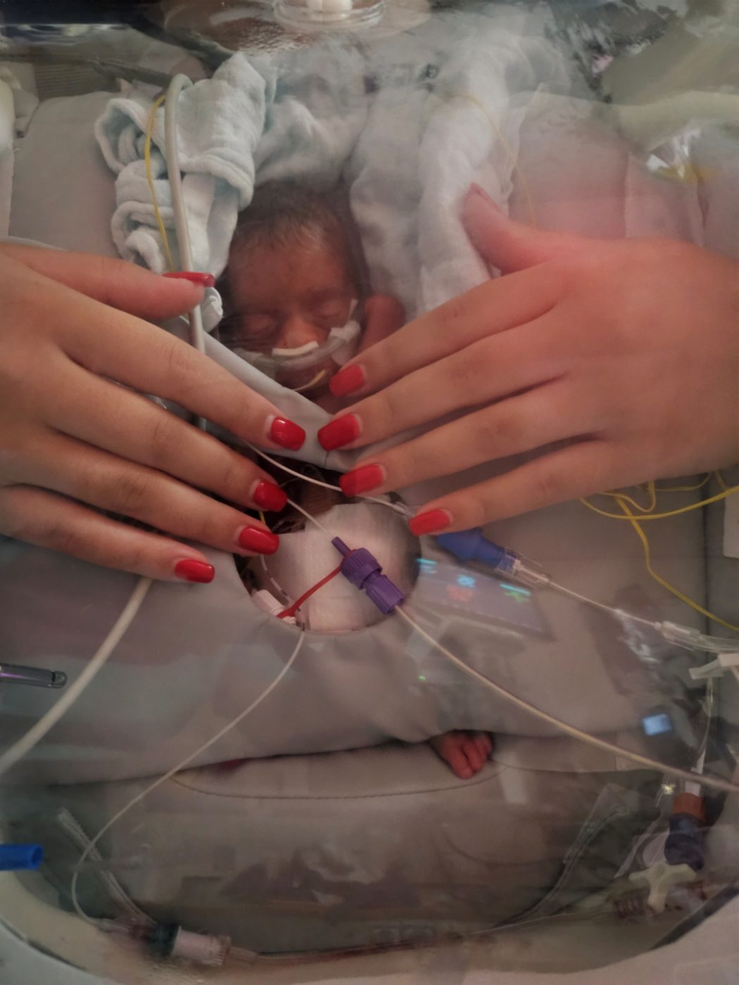 Both parents' hands on their baby through the access ports, with umbilical lines and monitoring in place